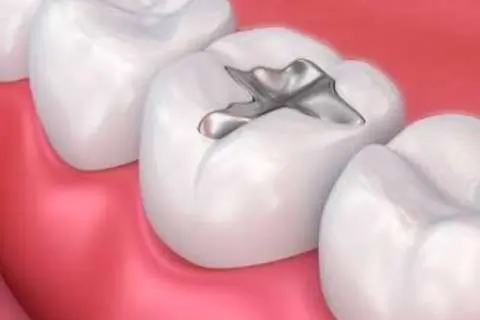 Karies- und Füllungstherapie