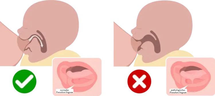 Zungen- und Lippenbändchen